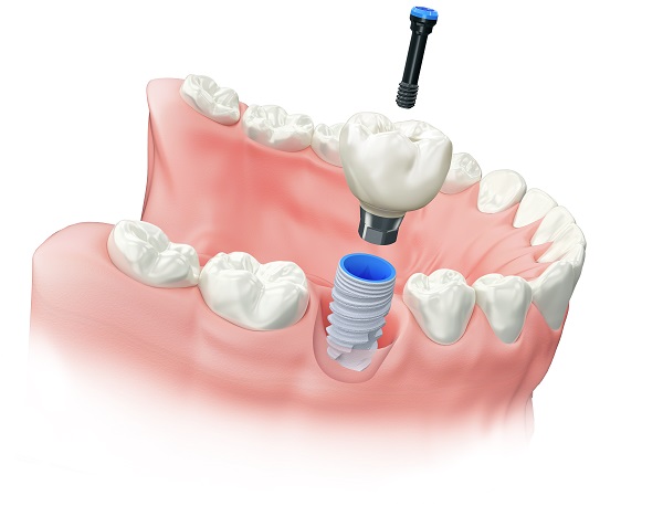 Implants - Dentist West Edmonton - Copperwood Dental