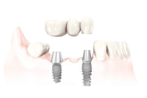 Implants - Dentist West Edmonton - Copperwood Dental