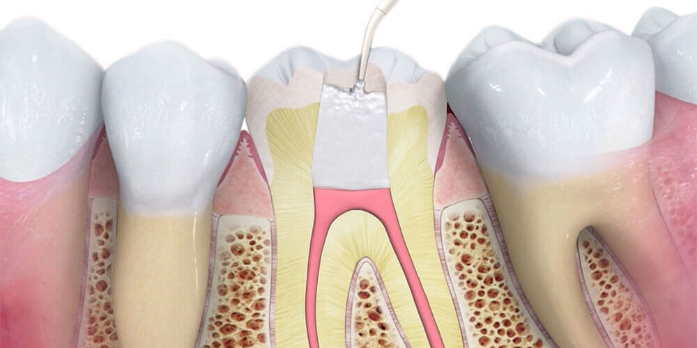 Root Canal Treatment - Dentist West Edmonton - Copperwood Dental
