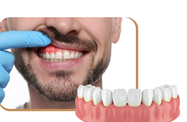 Gum Disease Treatment in West Edmonton