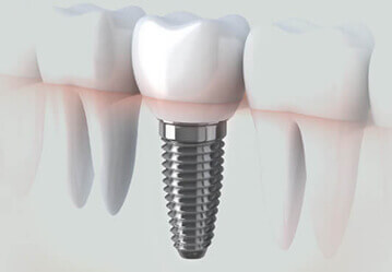 Dental Implants in West Edmonton