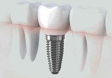 Dental Implants in  West Edmonton